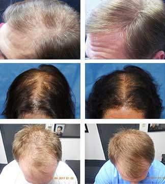 laser hair loss treatment therapy mclean alexandria virginia