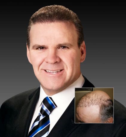 Best Hair Transplants Washington, DC, Grow Your Hair Back™ Hair Transplant Clinic