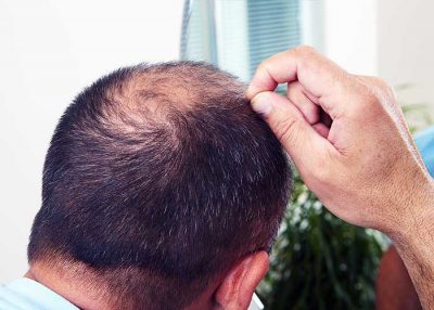 Telogen Effluvium Hair Loss - Grow Your Hair Back Hair Restoration Washington DC