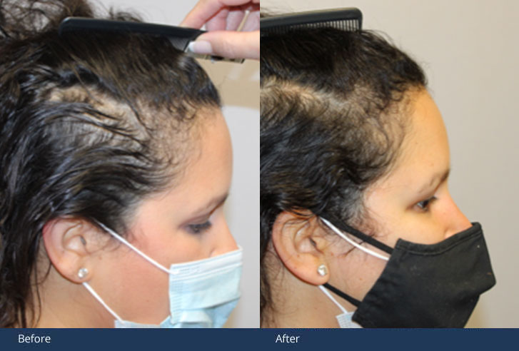 Tamo before and after her procedure