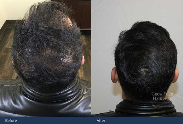 GYHB EHT Hair Loss treatment Before After 01