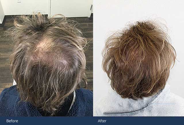 GYHB EHT Hair Loss Treatment Before After 02