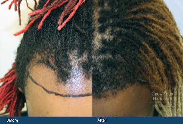 GYHB Hair Transplant Results Female 01