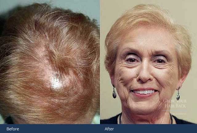 GYHB Hair Transplant Results Female 03