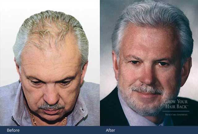 GYHB Hair Transplant Results Male 02