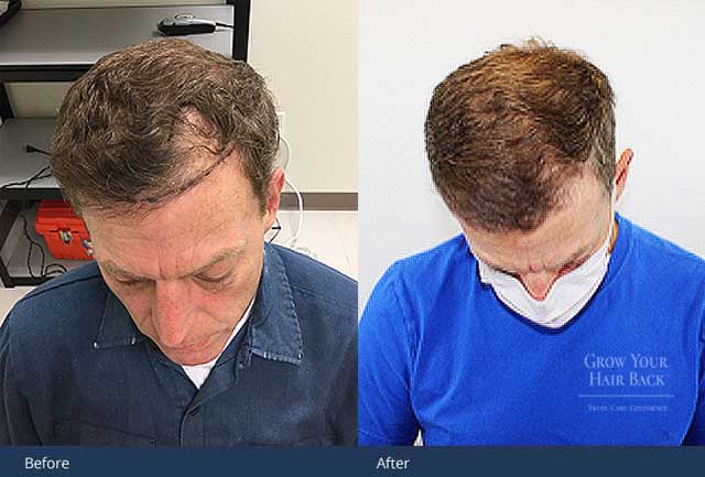 GYHB Hair Transplant Male 03