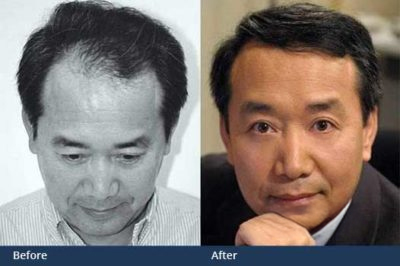 Hair Restoration Washington DC GYHB Hair Transplant Clinic