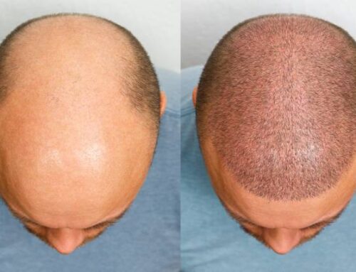 The Complete Hair Transplant Recovery Timeline: What to Expect