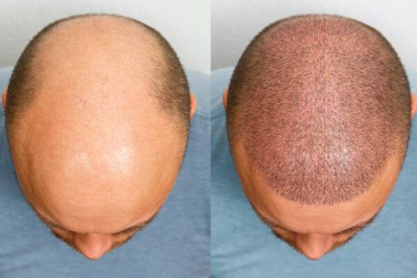 hair transplant recovery timeline mclean va washington dc