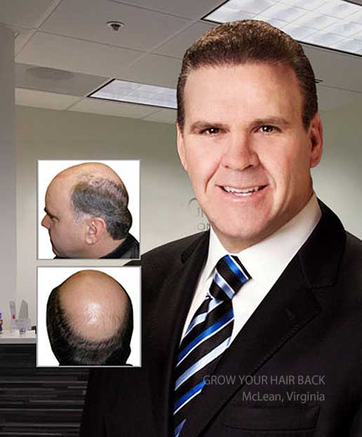 washington dc hair transplant restoration northern virginia