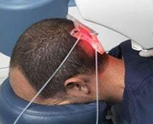 artas robotic hair transplantation mclean virginia