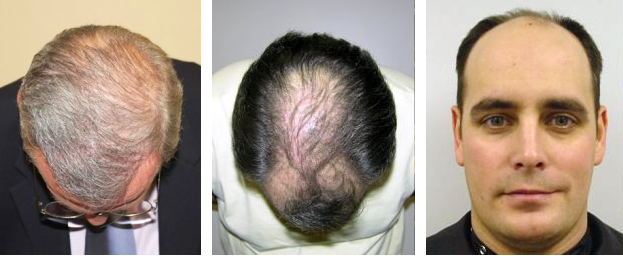 hair transplant cost fairfax county mclean virginia