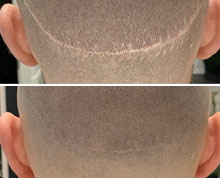 hair transplant revision repair mclean virginia