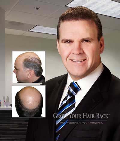 McLean Virginia Hair Transplantation Clinic - Grow Your Hair Back