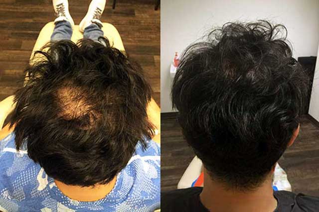 Grow Your Hair Back Hair Transplant Clinic Before After 01