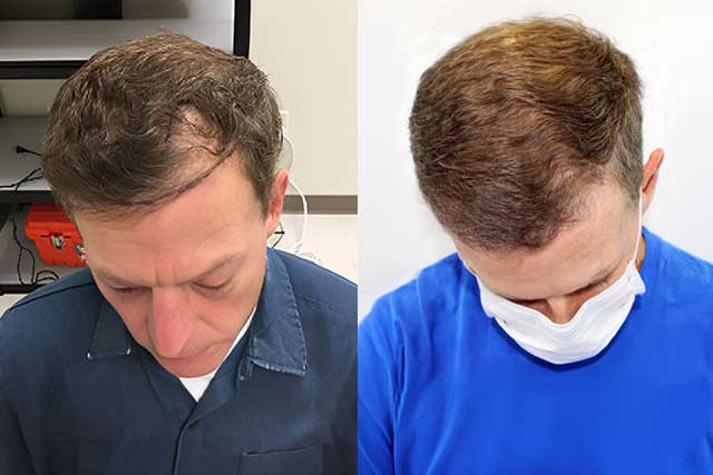 Grow Your Hair Back Hair Transplant Clinic Before After 02