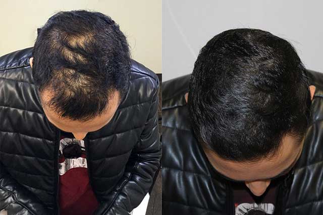 Grow Your Hair Back Hair Transplant Clinic Before After 04