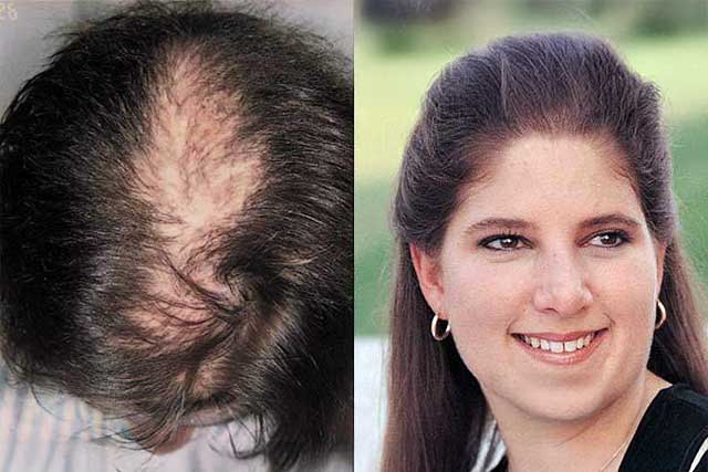 Grow Your Hair Back Hair Transplant Clinic Before After 05