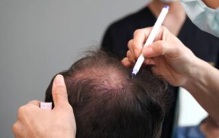 Cost Hair Transplant Northern VA